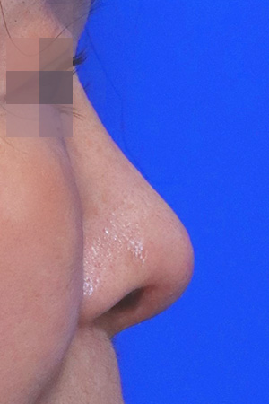 Kobijou Rhinoplasty Clinic: Side view, after at 10 weeks. Original eye masking retained.